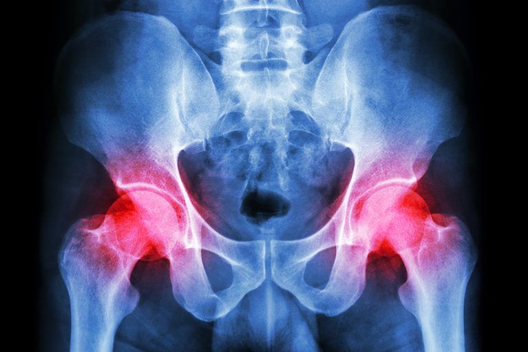 Hip dysplasia to hip arthritis Kentucky Living